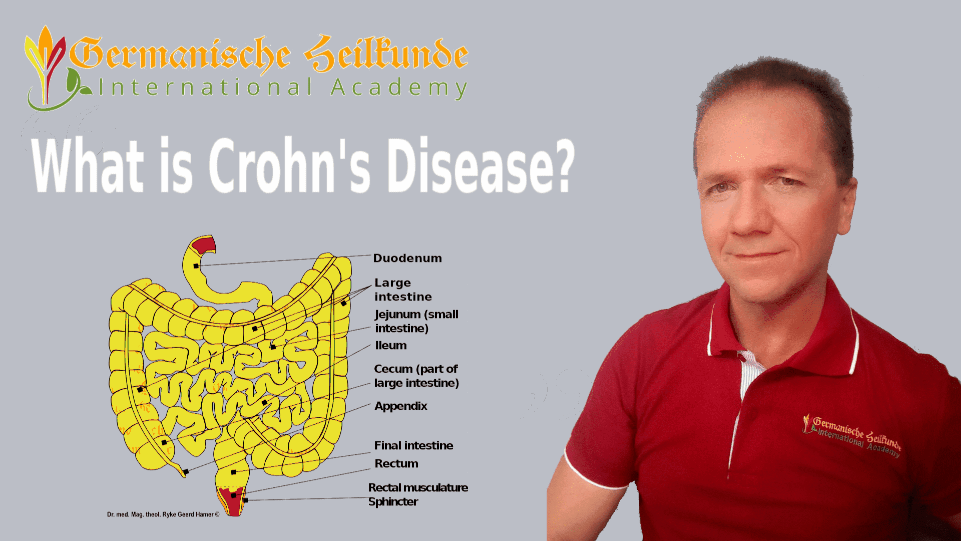 what causes Crohn's disease